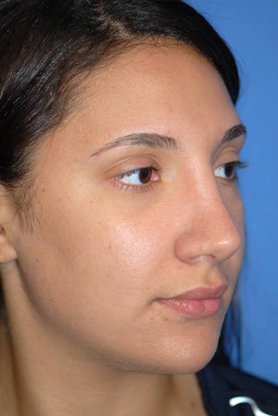 Rhinoplasty Before & After Gallery - Patient 5883880 - Image 4