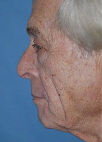 Facelift and Mini Facelift Gallery - Patient 5883883 - Image 1