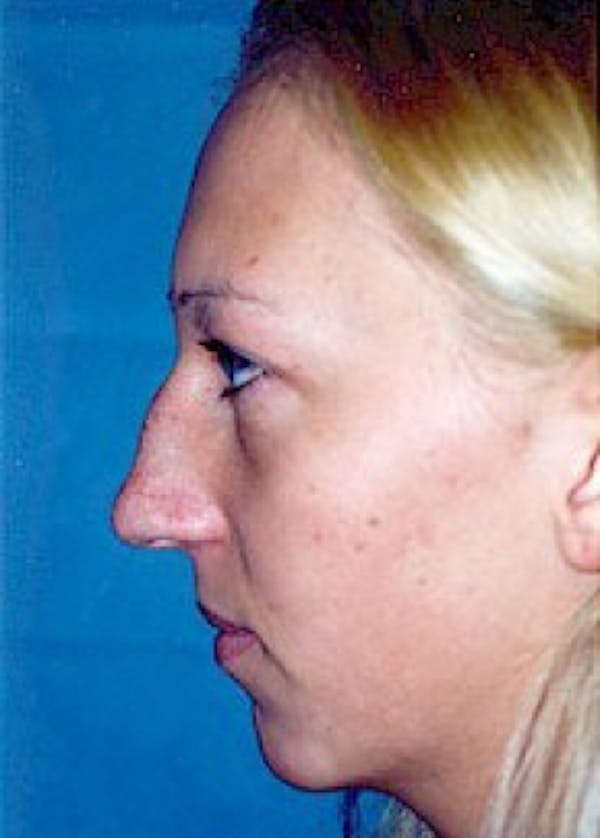 Chin & Cheek Implants Before & After Gallery - Patient 5883882 - Image 1