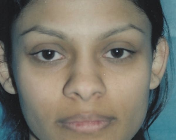 Otoplasty Before & After Gallery - Patient 5883881 - Image 1