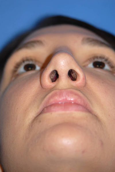 Rhinoplasty Before & After Gallery - Patient 5883880 - Image 6