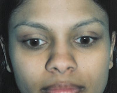 Otoplasty Before & After Gallery - Patient 5883881 - Image 2