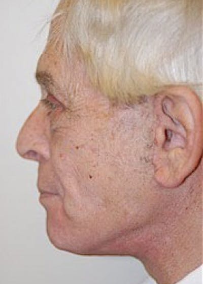 Facelift and Mini Facelift Before & After Gallery - Patient 5883883 - Image 2