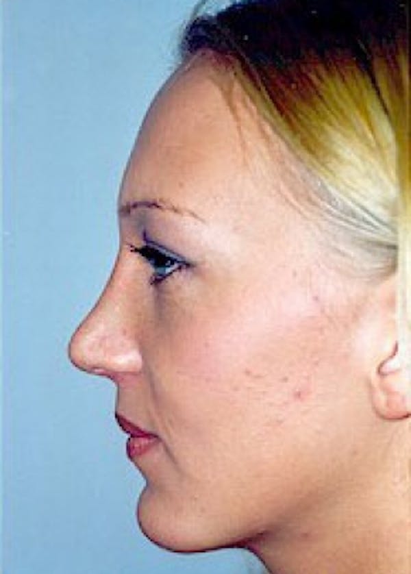 Chin & Cheek Implants Before & After Gallery - Patient 5883882 - Image 2