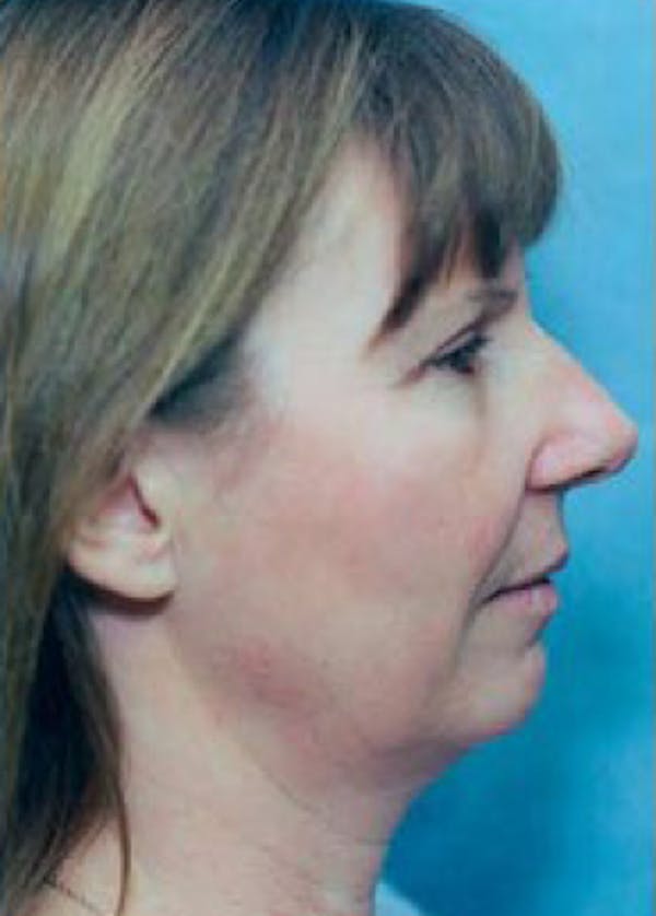 Facelift and Mini Facelift Gallery - Patient 5883886 - Image 1