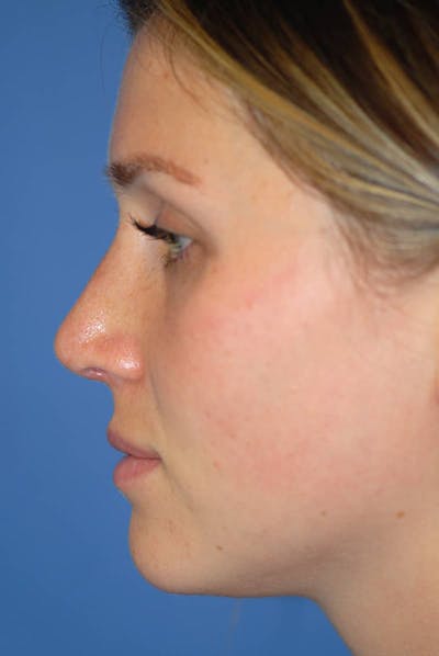 Plastic surgery patient at Allure Plastic Surgery