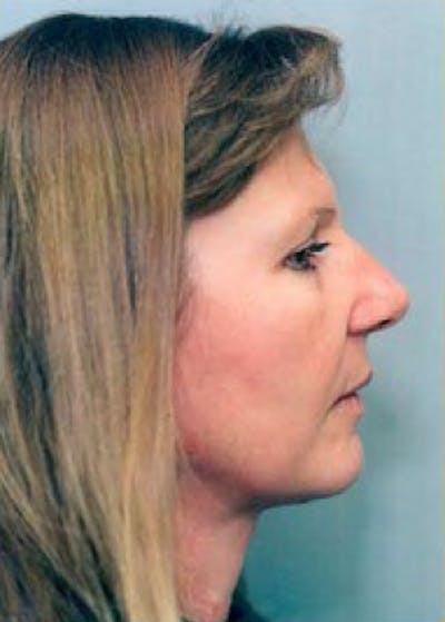 Facelift and Mini Facelift Before & After Gallery - Patient 5883886 - Image 2