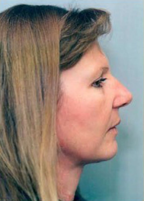 Facelift and Mini Facelift Before & After Gallery - Patient 5883886 - Image 2