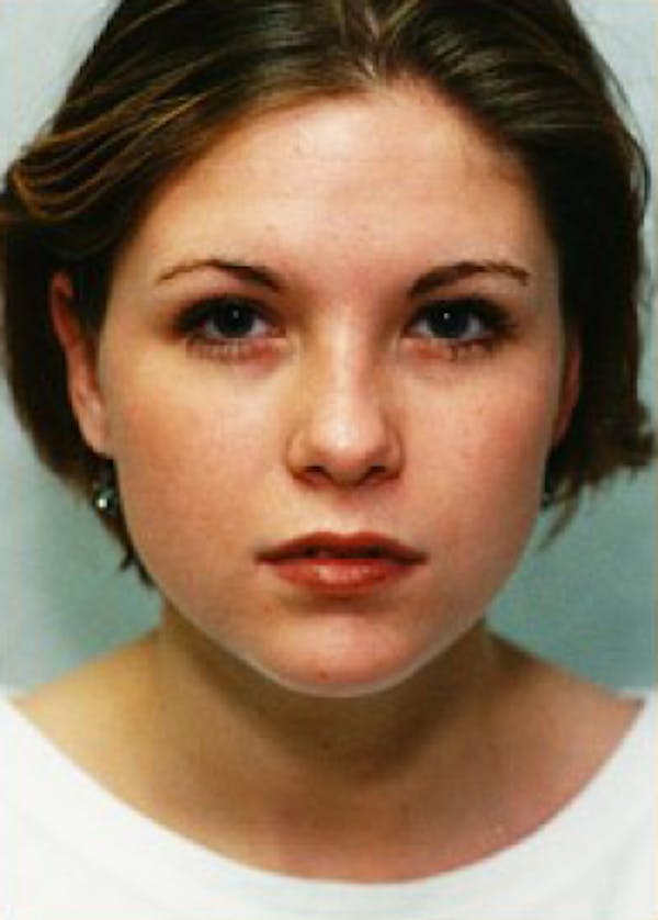 Otoplasty Before & After Gallery - Patient 5883887 - Image 2