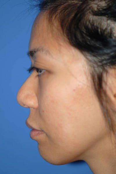 Rhinoplasty Before & After Gallery - Patient 5883889 - Image 1