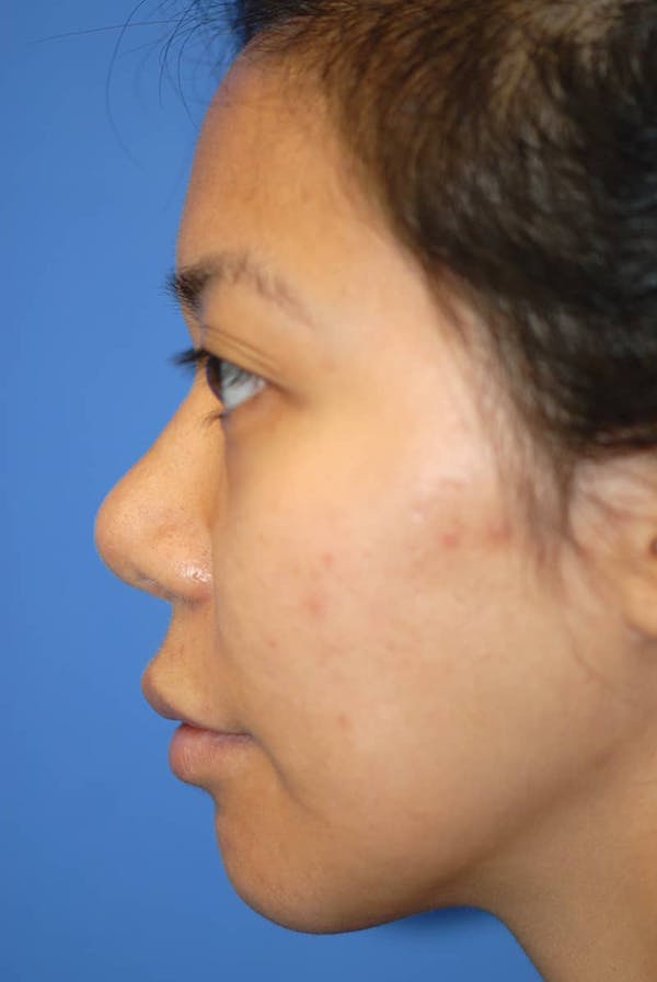 Rhinoplasty Before & After Gallery - Patient 5883889 - Image 2