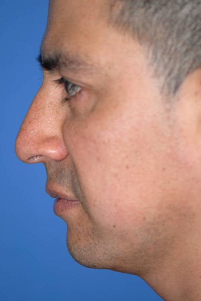 Rhinoplasty Before & After Gallery - Patient 5883892 - Image 1