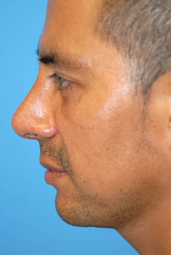 Rhinoplasty Before & After Gallery - Patient 5883892 - Image 2