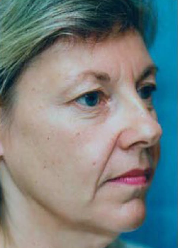 Facelift and Mini Facelift Gallery - Patient 5883894 - Image 1