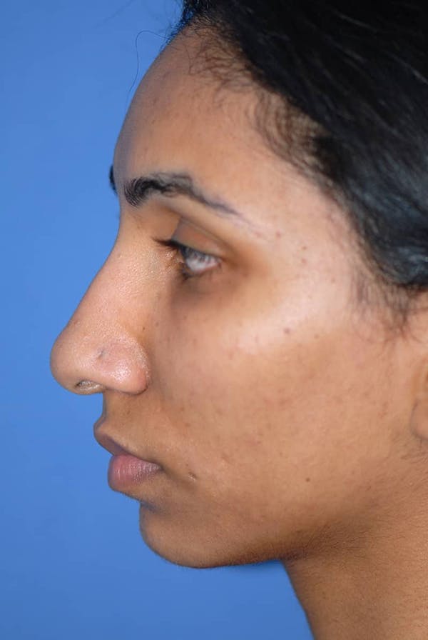Rhinoplasty Before & After Gallery - Patient 5883893 - Image 1