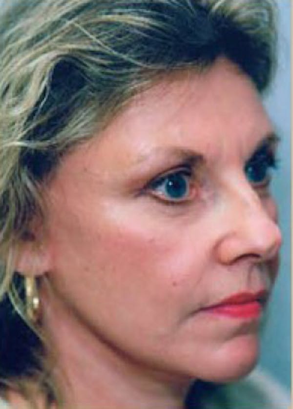 Facelift and Mini Facelift Before & After Gallery - Patient 5883894 - Image 2