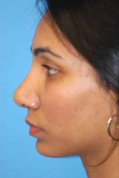 Rhinoplasty Before & After Gallery - Patient 5883893 - Image 2