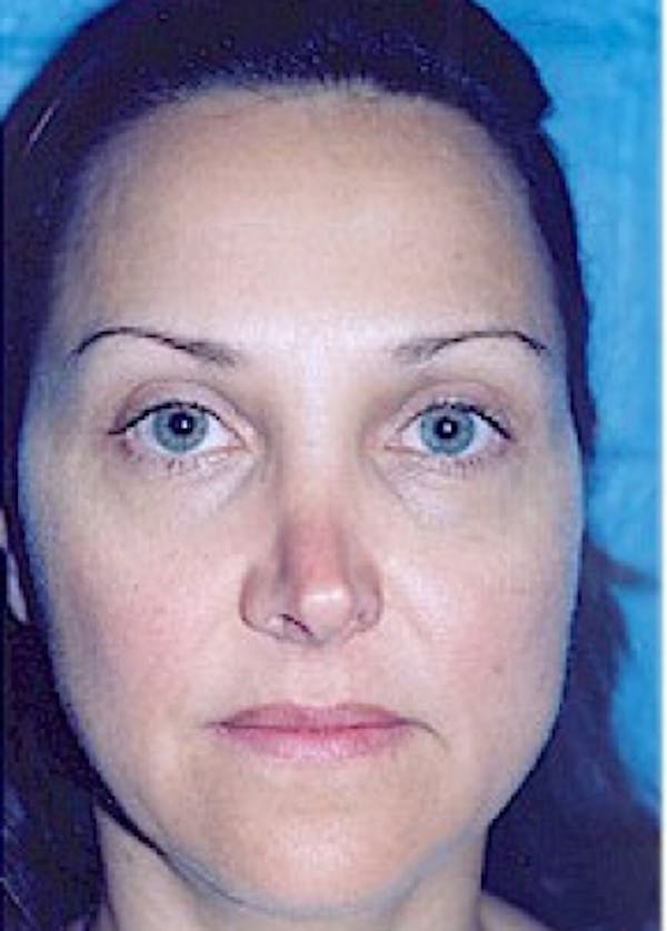 Rhinoplasty Before & After Gallery - Patient 5883905 - Image 1