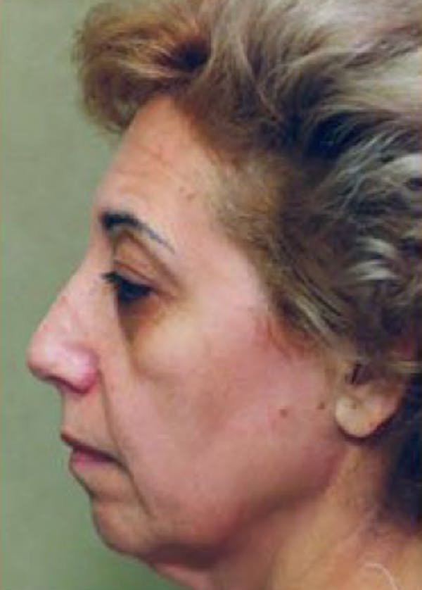 Facelift and Mini Facelift Before & After Gallery - Patient 5883898 - Image 1