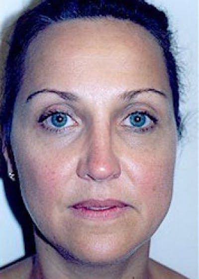 Rhinoplasty Before & After Gallery - Patient 5883905 - Image 2