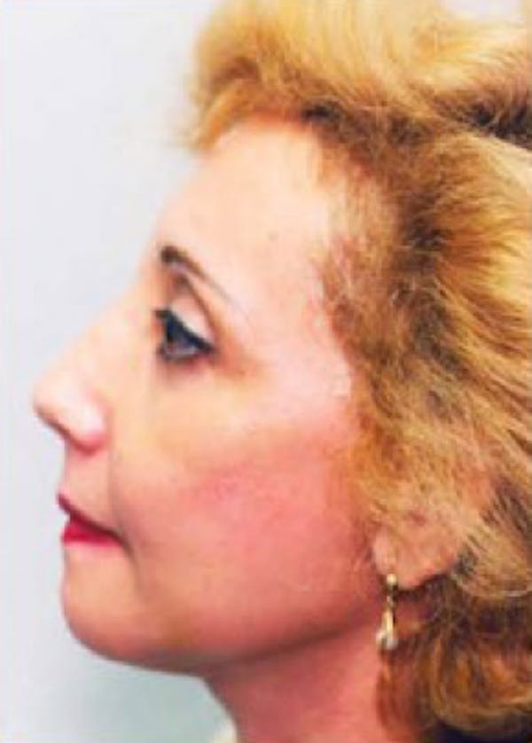 Facelift and Mini Facelift Gallery - Patient 5883898 - Image 2