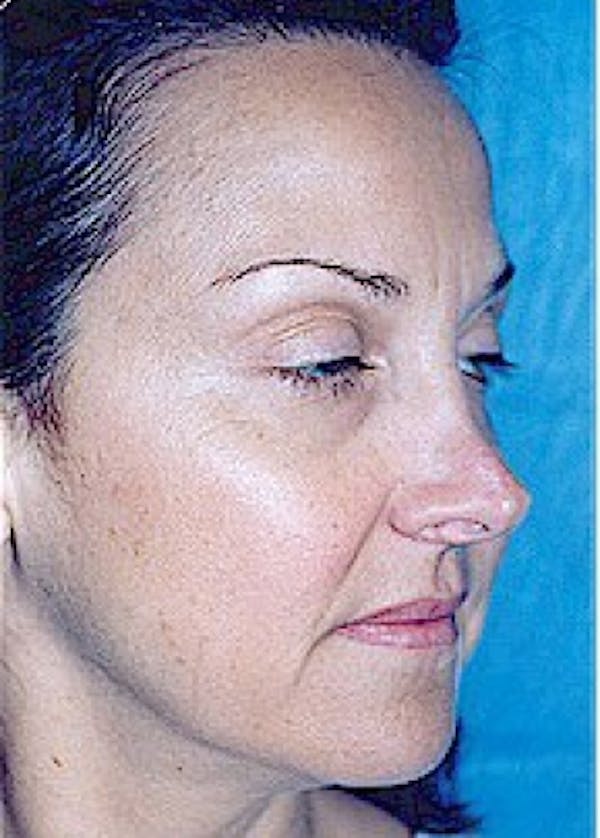 Rhinoplasty Before & After Gallery - Patient 5883905 - Image 3