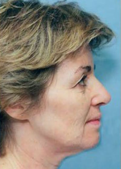 Facelift and Mini Facelift Before & After Gallery - Patient 5883901 - Image 1