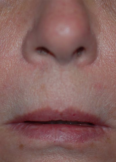 Lip Enhancement Before & After Gallery - Patient 5883902 - Image 1