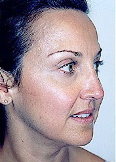 Rhinoplasty Before & After Gallery - Patient 5883905 - Image 4