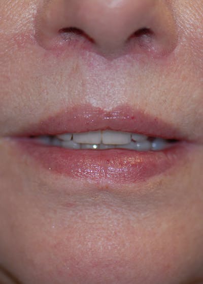 Lip Enhancement Before & After Gallery - Patient 5883902 - Image 2
