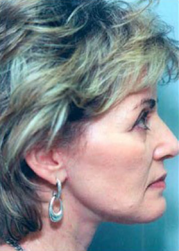 Facelift and Mini Facelift Before & After Gallery - Patient 5883901 - Image 2