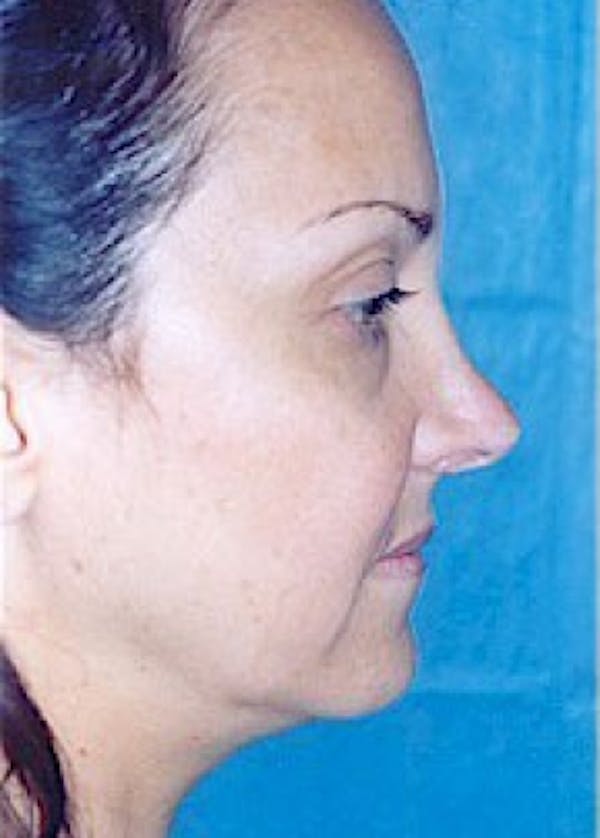 Rhinoplasty Before & After Gallery - Patient 5883905 - Image 5
