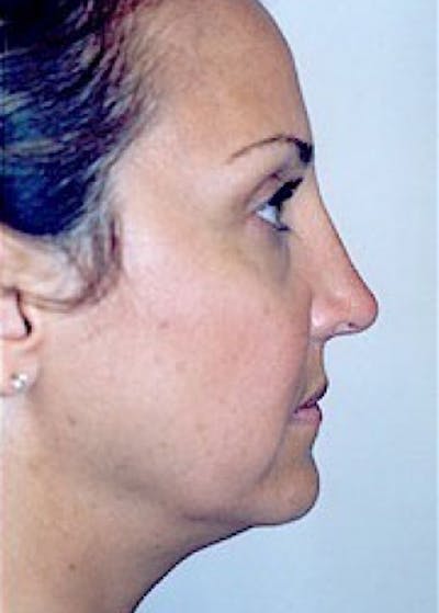 Rhinoplasty Before & After Gallery - Patient 5883905 - Image 6