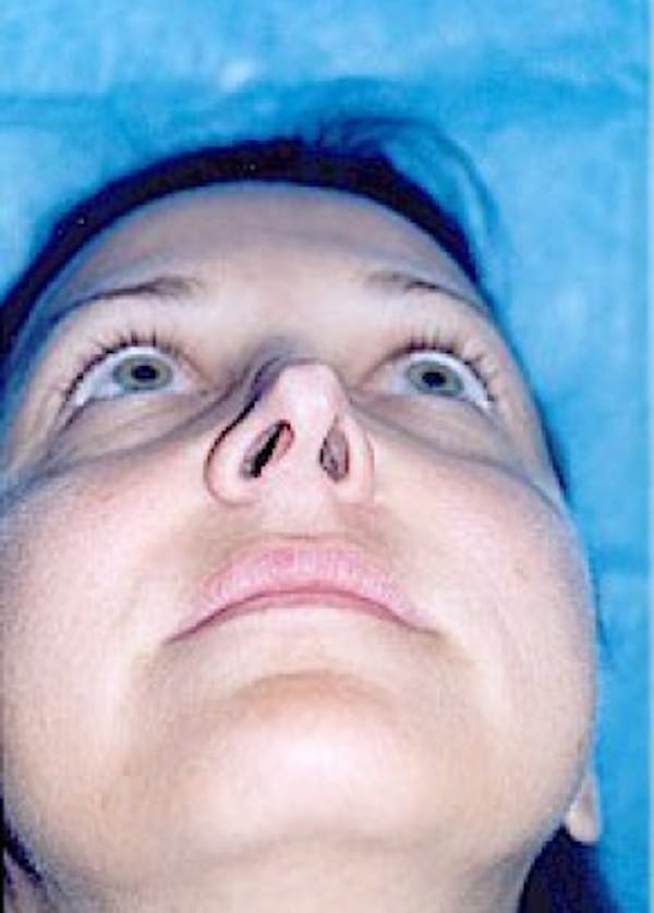 Rhinoplasty Before & After Gallery - Patient 5883905 - Image 7