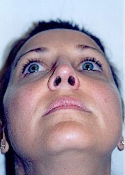 Rhinoplasty Before & After Gallery - Patient 5883905 - Image 8