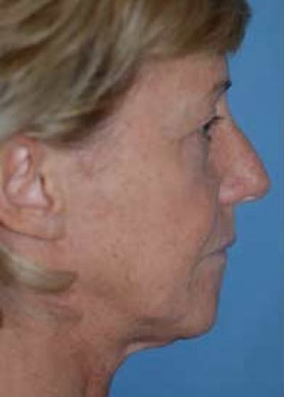 Facelift and Mini Facelift Gallery - Patient 5883907 - Image 1
