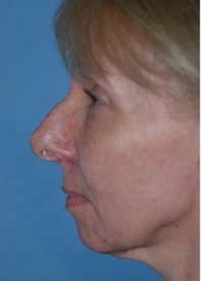 Rhinoplasty Before & After Gallery - Patient 5883910 - Image 1