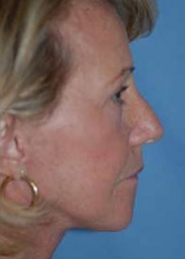 Facelift and Mini Facelift Before & After Gallery - Patient 5883907 - Image 2