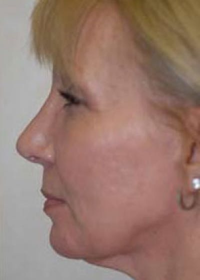 Rhinoplasty Before & After Gallery - Patient 5883910 - Image 2