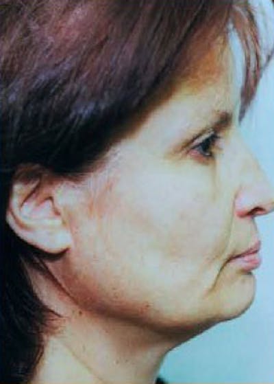 Facelift and Mini Facelift Before & After Gallery - Patient 5883913 - Image 1