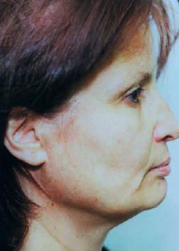 Facelift and Mini Facelift Before & After Gallery - Patient 5883913 - Image 1