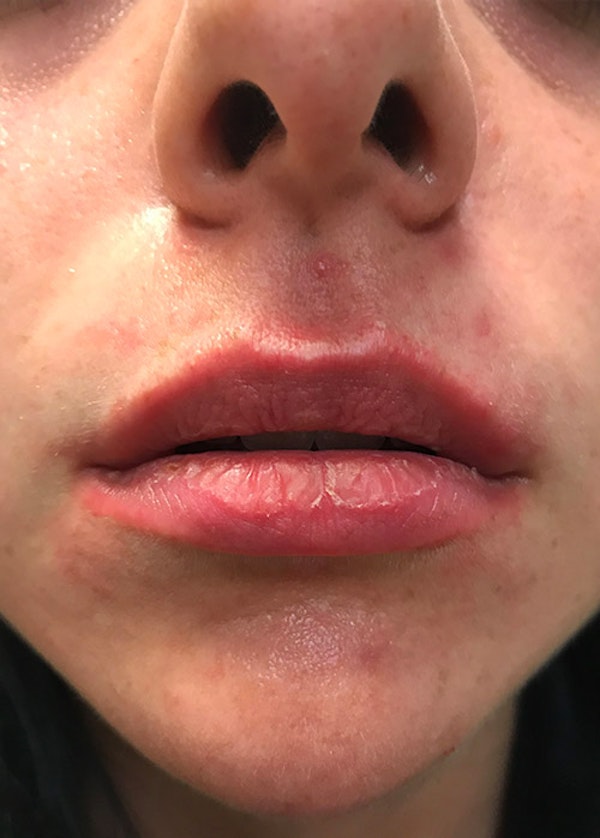 Lip Enhancement