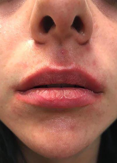 Lip Enhancement Before & After Gallery - Patient 5883912 - Image 1