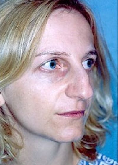 Rhinoplasty Before & After Gallery - Patient 5883916 - Image 1