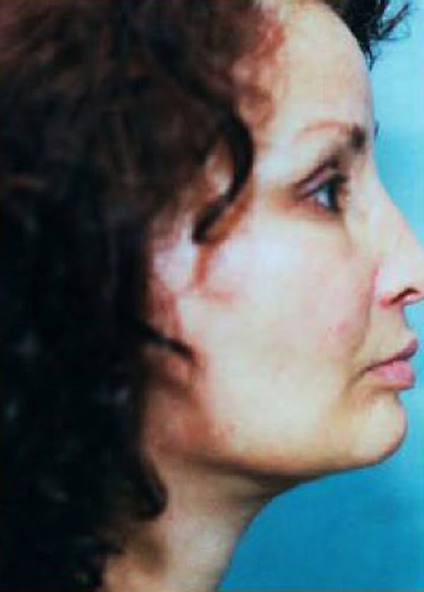 Facelift and Mini Facelift Before & After Gallery - Patient 5883913 - Image 2