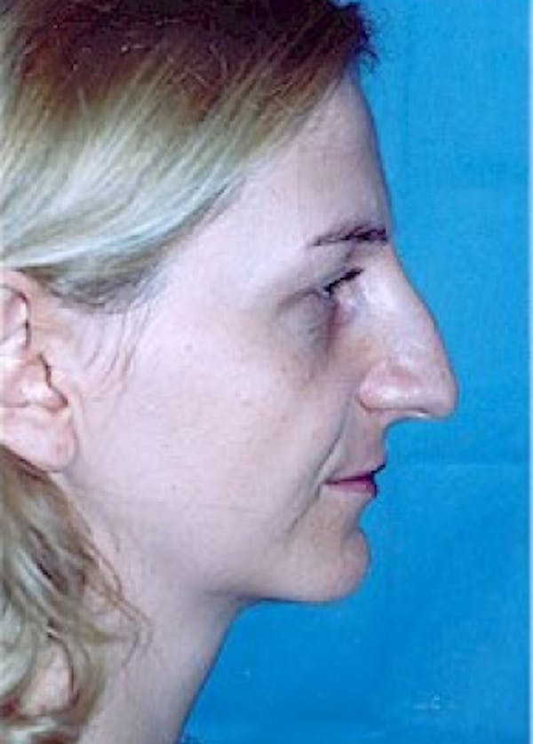 Rhinoplasty Before & After Gallery - Patient 5883916 - Image 3