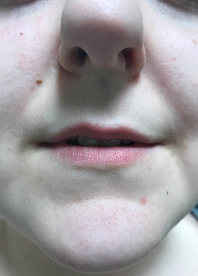 Lip Enhancement Before & After Gallery - Patient 5883915 - Image 1