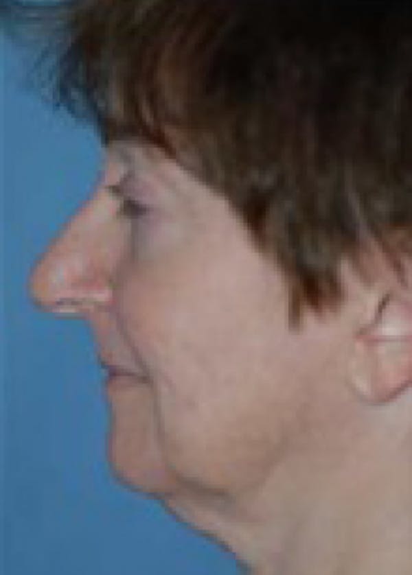 Facelift and Mini Facelift Gallery - Patient 5883917 - Image 1