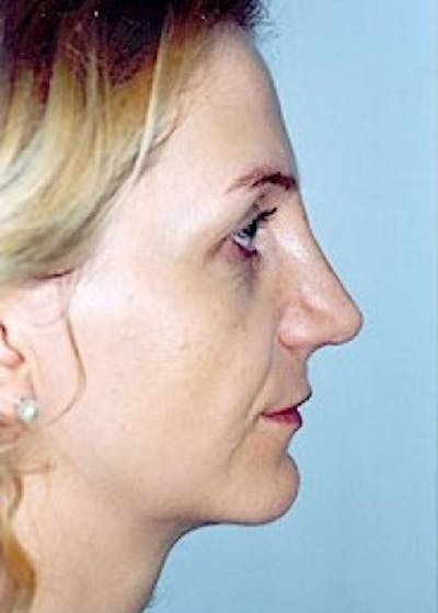 Rhinoplasty Before & After Gallery - Patient 5883916 - Image 4