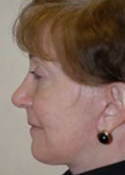 Facelift and Mini Facelift Before & After Gallery - Patient 5883917 - Image 2